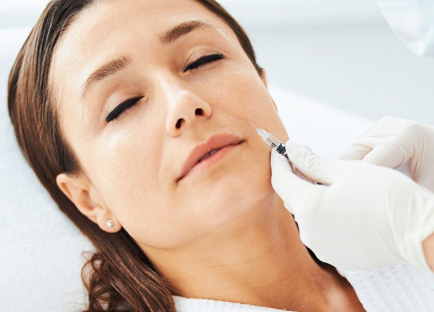 فیلر خط خنده در صادقیه تهران (Nasolabial Filler)