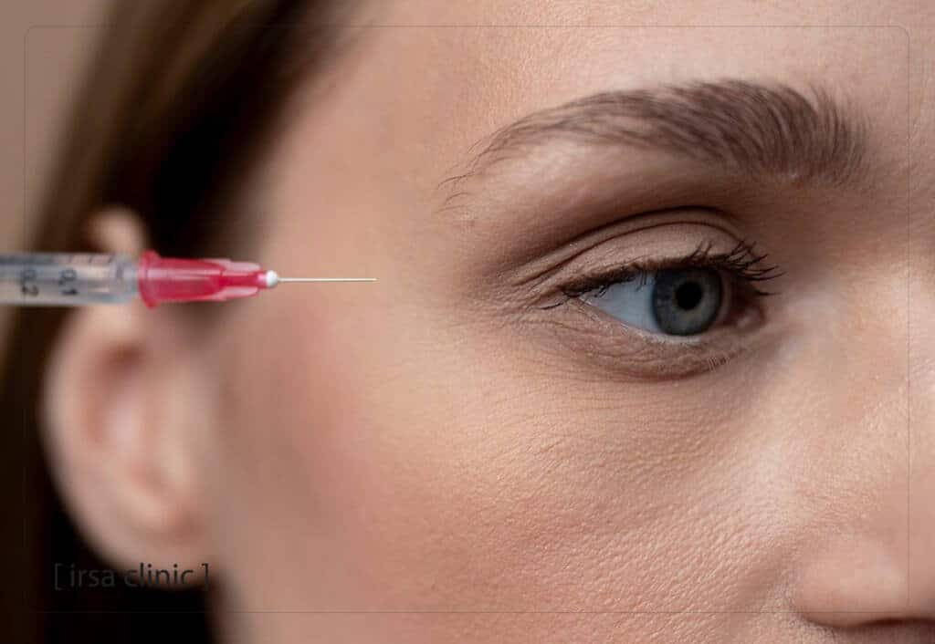 بوتاکس چشم گربه‌ای در صادقیه تهران (Cat Eye Botox)